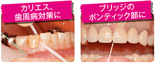 バトラーイージースレッドフロスの説明歯間部に挿入している写真
