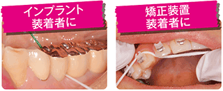 バトラーイージースレッドフロスの説明矯正ブラケット・ブリッジ下部の清掃