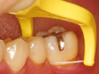 こどものフロス動機づけ