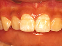 こどもの仕上げ磨きのフロッシング