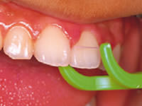 こどものフロス動機づけ