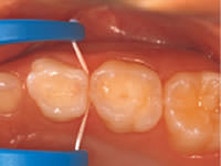 こどもの仕上げ磨きのフロッシング